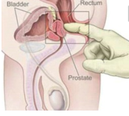 睾丸炎常见的检查方法