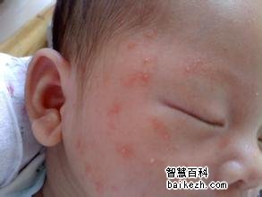 小儿常见皮疹怎样治疗才好？