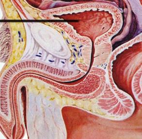 认识前列腺钙化是什么