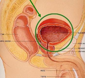 如何抵制前列腺钙化愈后复发