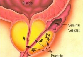 前列腺钙化到底是什么病