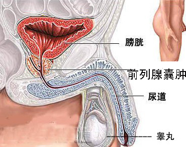 前列腺囊肿会给身体带来的危害