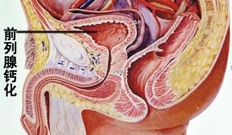 前列腺钙化复发的原因是什么