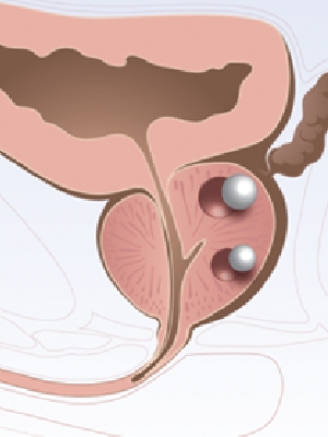 前列腺钙化的辅助检查