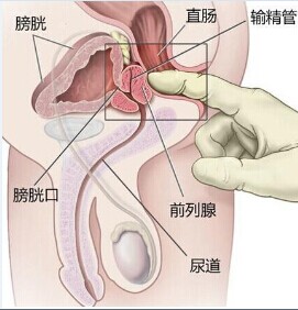 前列腺囊肿的基本护理常规措施