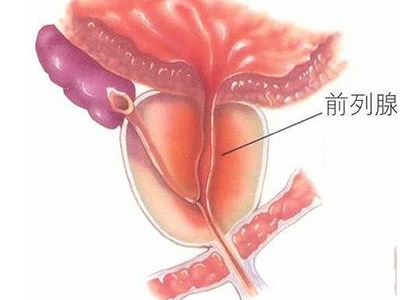 前列腺钙化的多种诊断方法