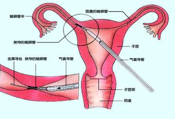 输卵管阻塞怎么办？
