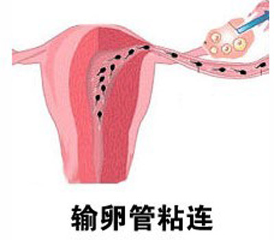 月经异常，要警惕输卵管粘连侵袭
