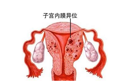 子宫内膜异位症的有哪些临床表现