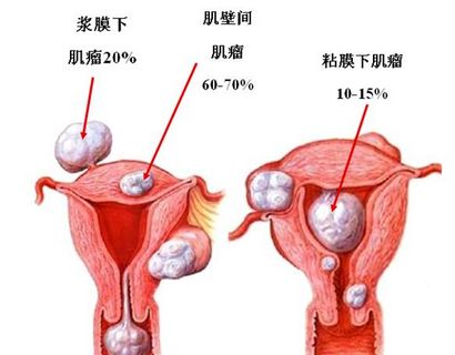 女性出现子宫肌瘤怎么治?