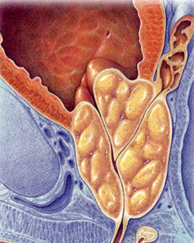 有关前列腺结石的饮食指导的问题