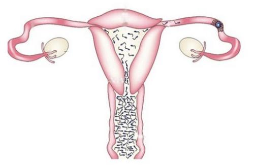 输卵管堵塞如何自我诊断?