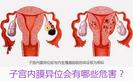 子宫内膜异位症对女性的危害有哪些