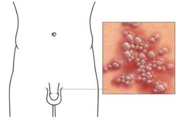 生殖器疱疹的危害有哪些应该如何治疗
