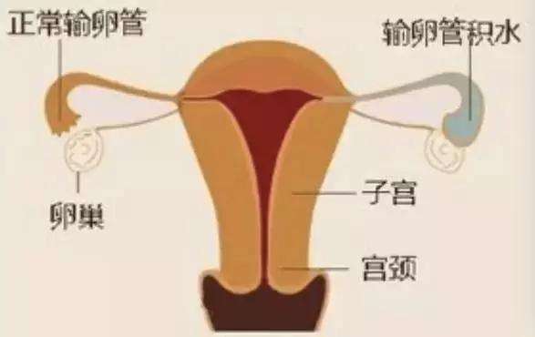 什么是输卵管积液?输卵管积液的症状有哪些?