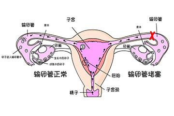 输卵管堵塞引起的原因及治疗和预防的方法都有