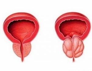 前列腺增生的症状及预防