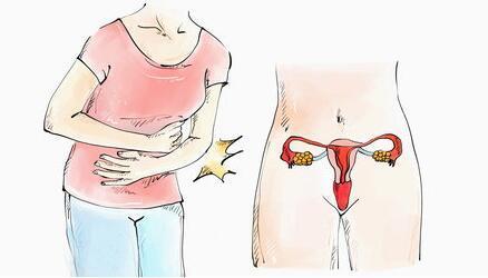 惊！子宫肌瘤会导致女性不孕