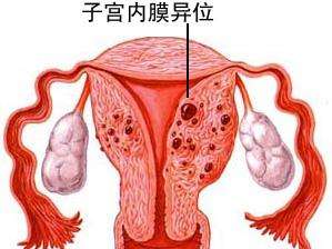 引起子宫内膜异位囊肿病因及治疗和预防