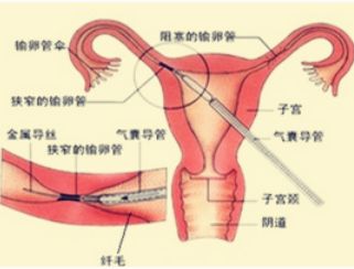 输卵管结核症状及与不孕的关系和食疗方法