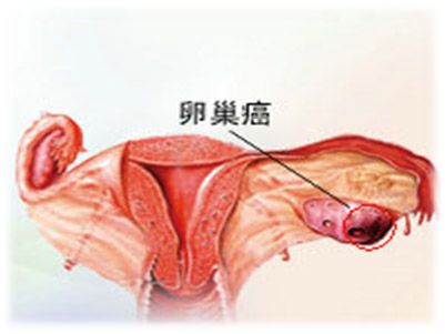 导致女性卵巢癌的原因及症状和如何预防