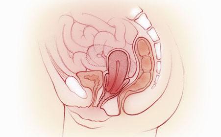 什么是子宫脱垂，有哪些常见原因及临床分度