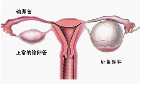 引起卵巢囊肿常见症状及危害和中医治疗