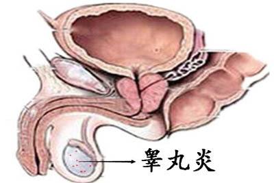 睾丸炎常见症状及危害和预防
