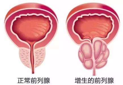 前列腺增生的原因与症状及预防