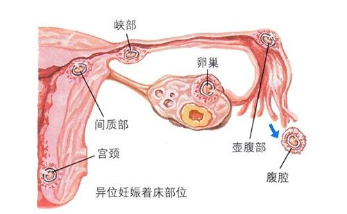输卵管堵塞致不孕 盘点输卵管堵塞的6大表现