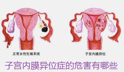 子宫内膜异位症有哪些危害?