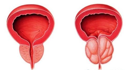 前列腺肥大的原因与危害及预防