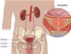 治疗前列腺囊肿方法以及合理的预防