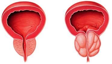 前列腺增生的五大危害