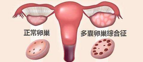 正常卵巢和多囊卵巢的区别