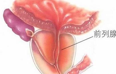 前列腺钙化的症状表现和预防