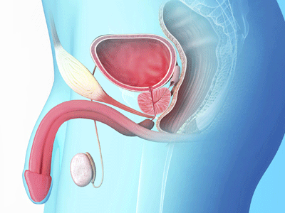 前列腺结石的病因和危害及治疗