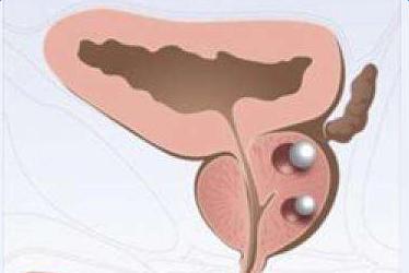 前列腺结石的形成过程和症状及诊断