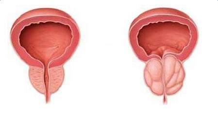 前列腺肥大的原因有哪些？如何预防
