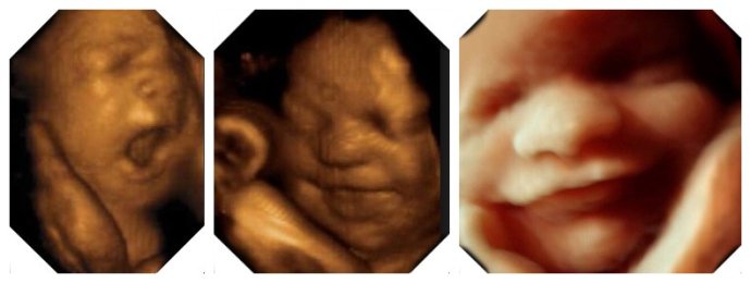 孕妈怀孕五个月胎儿四维彩超是怎样的?