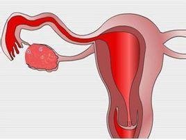 如何预防女性输卵管堵塞