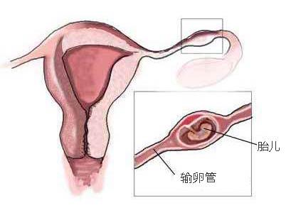 治疗输卵管不通的误区有哪些