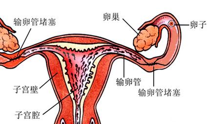 输卵管不通，这些办法可以帮助你怀孕