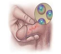 引起男性包皮炎的病因及如何预防包皮炎