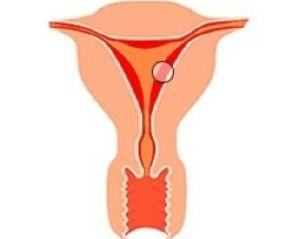 子宫内膜异位症症状是什么？