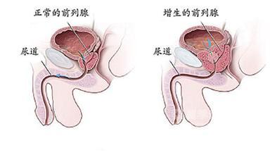 前列腺增生5大信号 前列腺增生预防措施