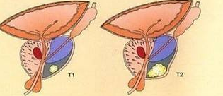 前列腺癌早期的四大症状 如何筛查前列腺癌?