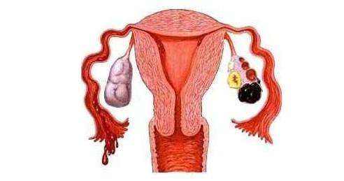 引起卵巢巧克力囊肿原因及治疗方法
