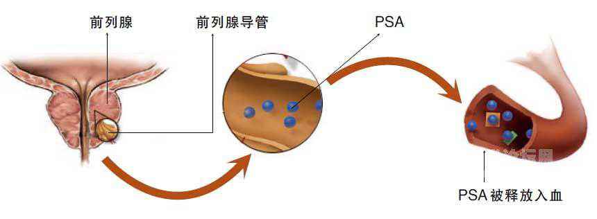 前列腺特异性抗原(PSA)介绍及注意事项