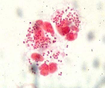 甘孜男性淋球菌怎么治疗,淋球菌感染症状有哪些